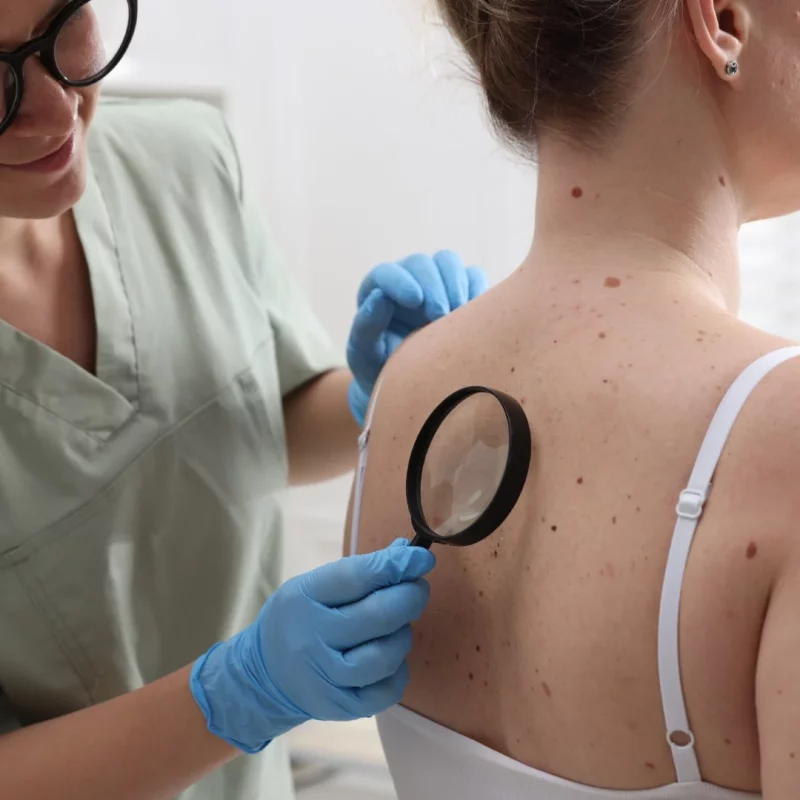 Doctor examining a mole during a skin check at Balwyn Health Care